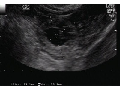 Rimini. Scambia gravidanza extrauterina con un banale mal di pancia: denunciato ginecologo. La Cronaca NQNews